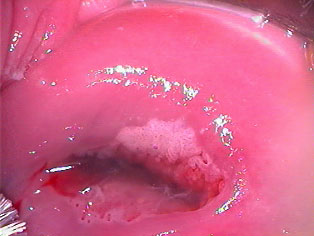 Colposcopy